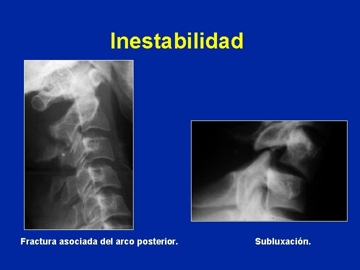 Inestabilidad Fractura asociada del arco posterior. Subluxación. 