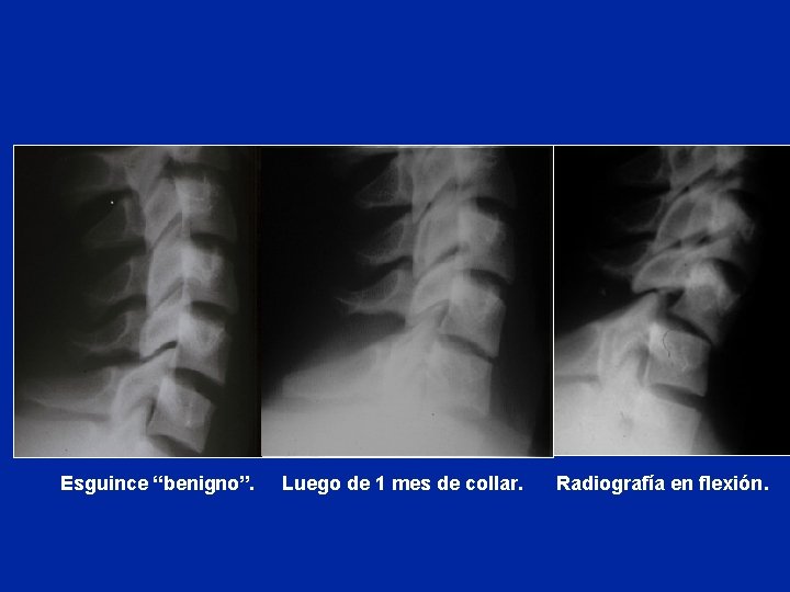 Esguince “benigno”. Luego de 1 mes de collar. Radiografía en flexión. 