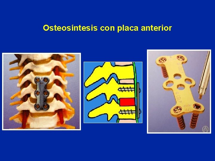 Osteosíntesis con placa anterior 