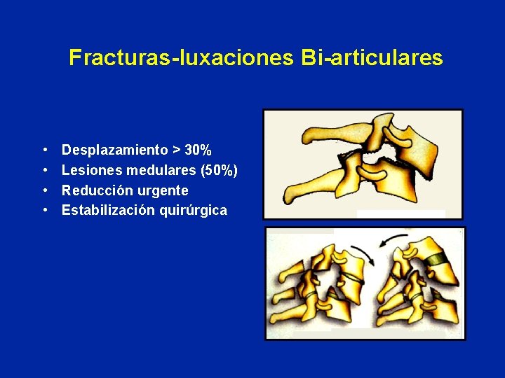 Fracturas-luxaciones Bi-articulares • • Desplazamiento > 30% Lesiones medulares (50%) Reducción urgente Estabilización quirúrgica