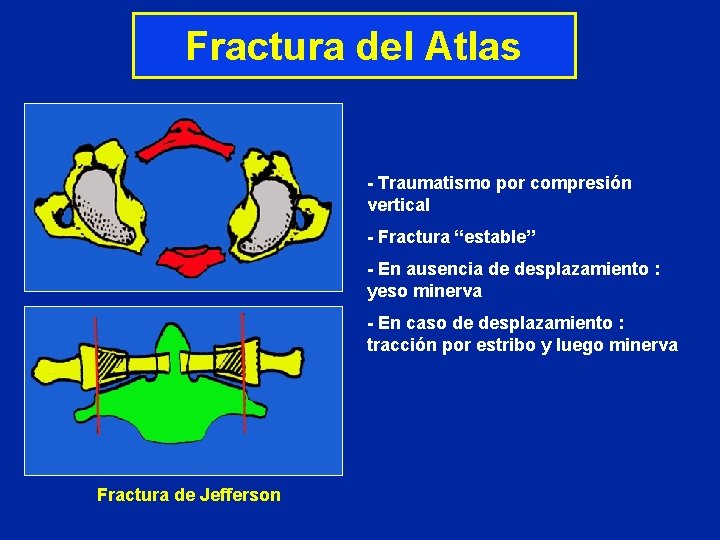 Fractura del Atlas - Traumatismo por compresión vertical - Fractura “estable” - En ausencia