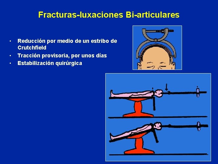Fracturas-luxaciones Bi-articulares • • • Reducción por medio de un estribo de Crutchfield Tracción