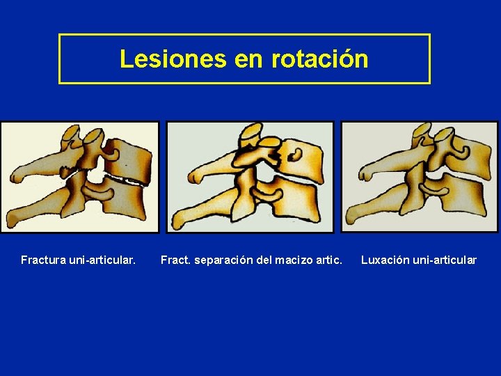 Lesiones en rotación Fractura uni-articular. Fract. separación del macizo artic. Luxación uni-articular 