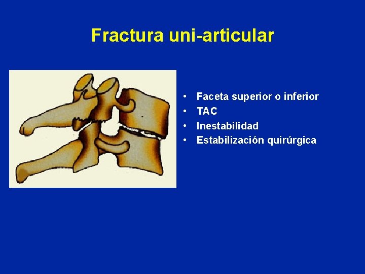 Fractura uni-articular • • Faceta superior o inferior TAC Inestabilidad Estabilización quirúrgica 