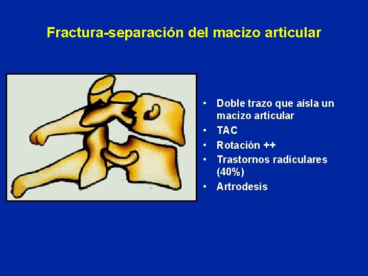 Fractura-separación del macizo articular • Doble trazo que aísla un macizo articular • TAC