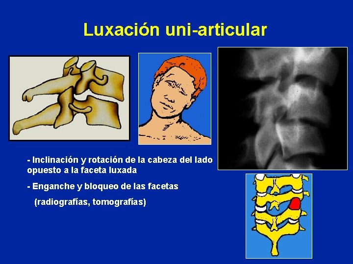Luxación uni-articular - Inclinación y rotación de la cabeza del lado opuesto a la