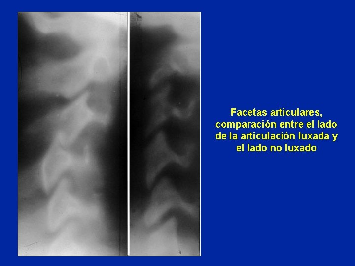 Facetas articulares, comparación entre el lado de la articulación luxada y el lado no
