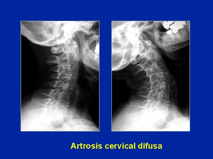 Artrosis cervical difusa 