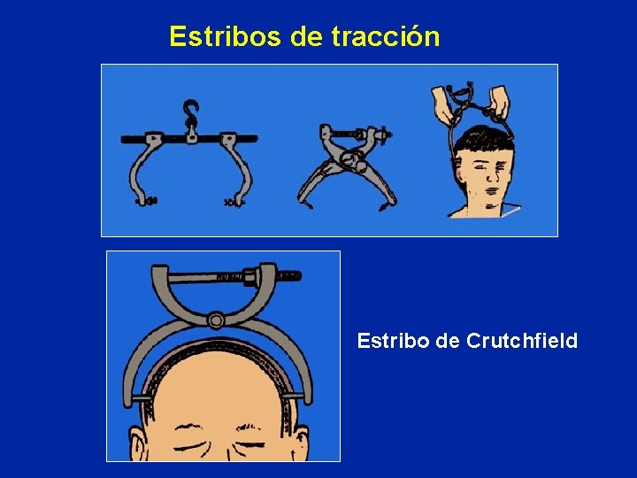 Estribos de tracción Estribo de Crutchfield 