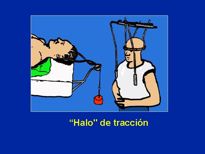 “Halo" de tracción 