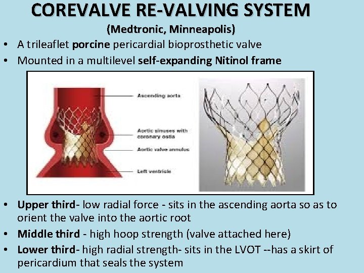 COREVALVE RE-VALVING SYSTEM (Medtronic, Minneapolis) • A trileaflet porcine pericardial bioprosthetic valve • Mounted