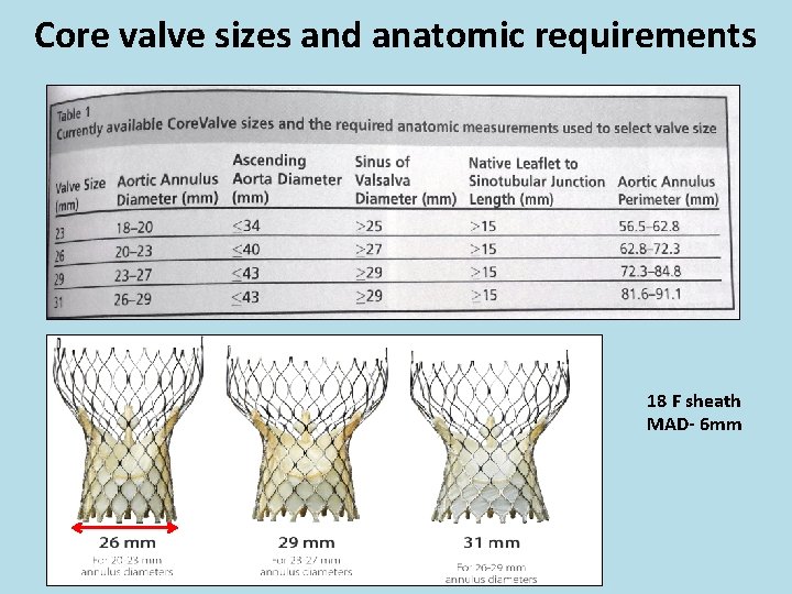 Core valve sizes and anatomic requirements 18 F sheath MAD- 6 mm 