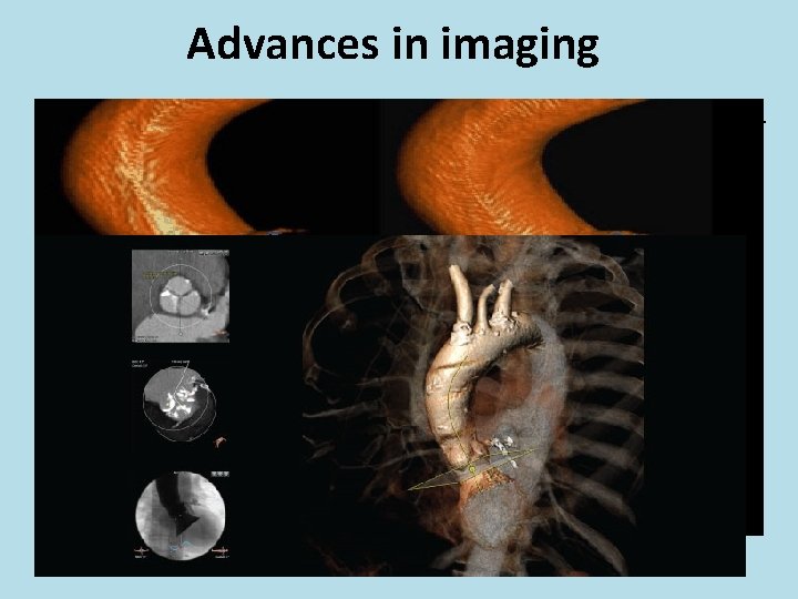 Advances in imaging • 3 mensio valve imaging with Phillips Heart. Navigator sytem •