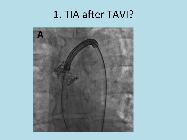 1. TIA after TAVI? 