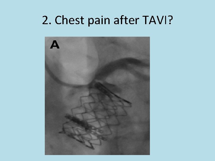 2. Chest pain after TAVI? 