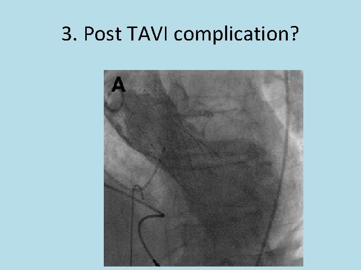 3. Post TAVI complication? 