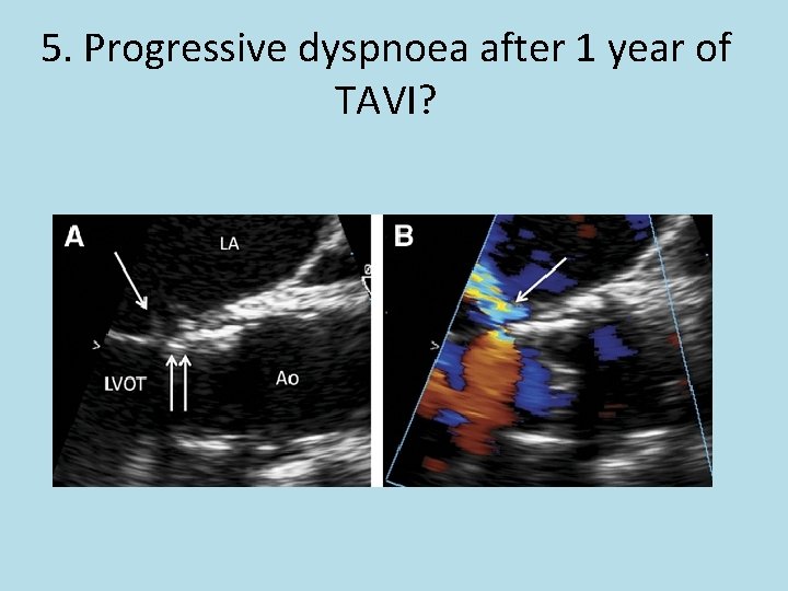 5. Progressive dyspnoea after 1 year of TAVI? 