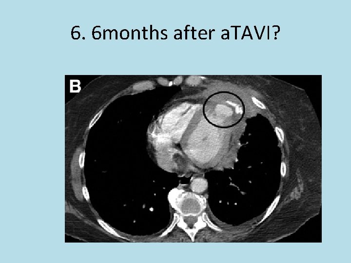 6. 6 months after a. TAVI? 