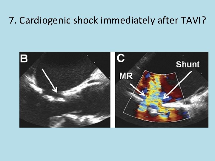 7. Cardiogenic shock immediately after TAVI? 