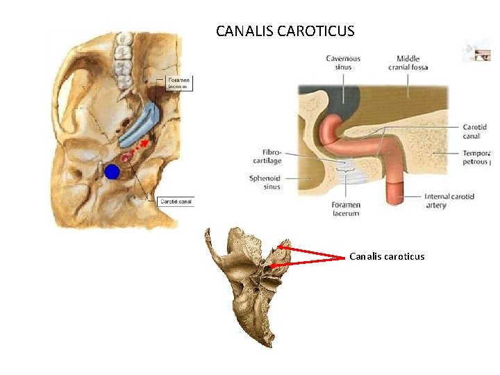 CANALIS CAROTICUS Canalis caroticus 