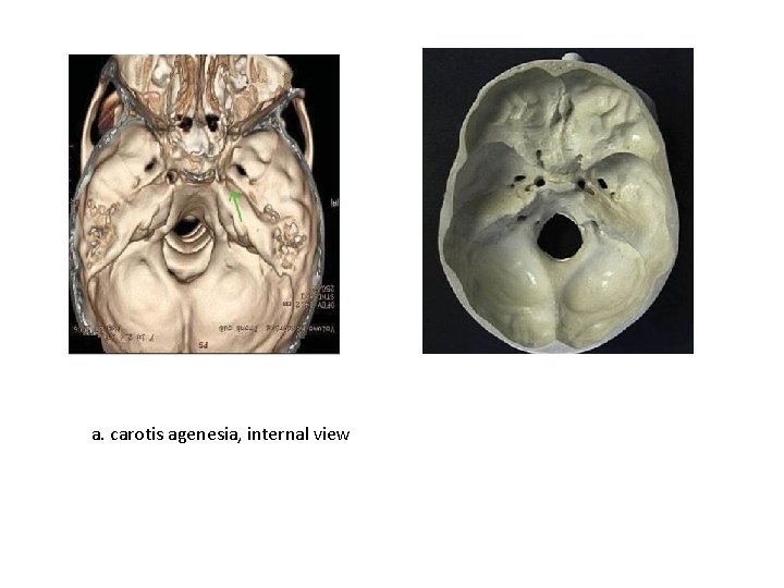 a. carotis agenesia, internal view 