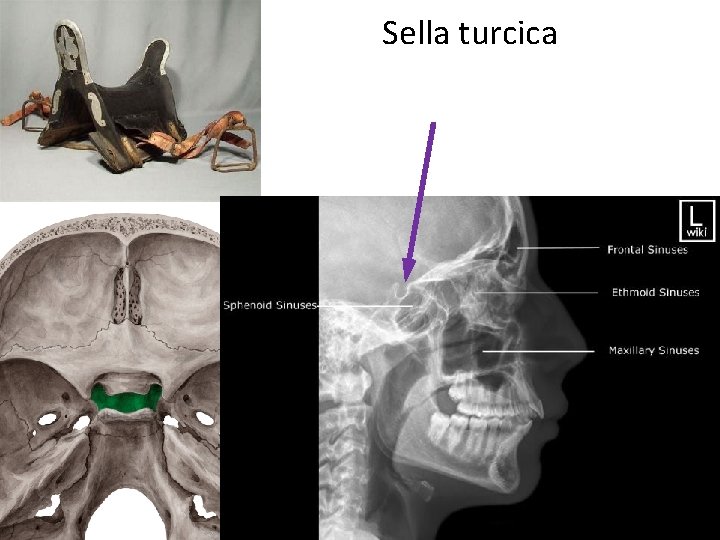 Sella turcica 