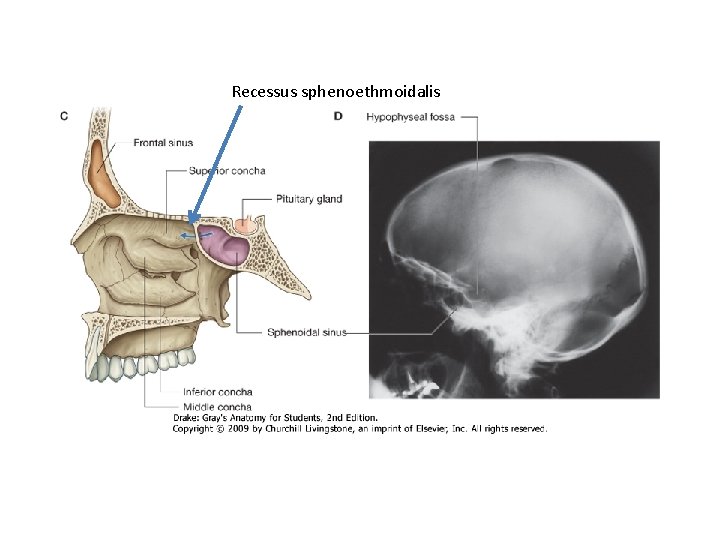 Recessus sphenoethmoidalis 