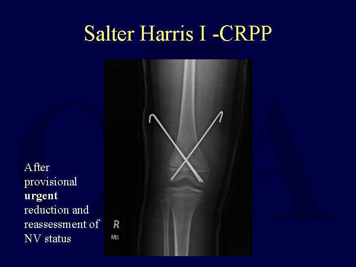 Salter Harris I -CRPP After provisional urgent reduction and reassessment of NV status 