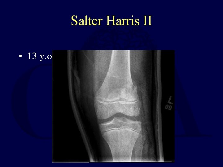 Salter Harris II • 13 y. o male s/p football injury 