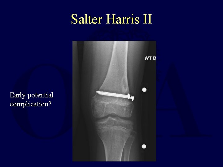 Salter Harris II Early potential complication? 