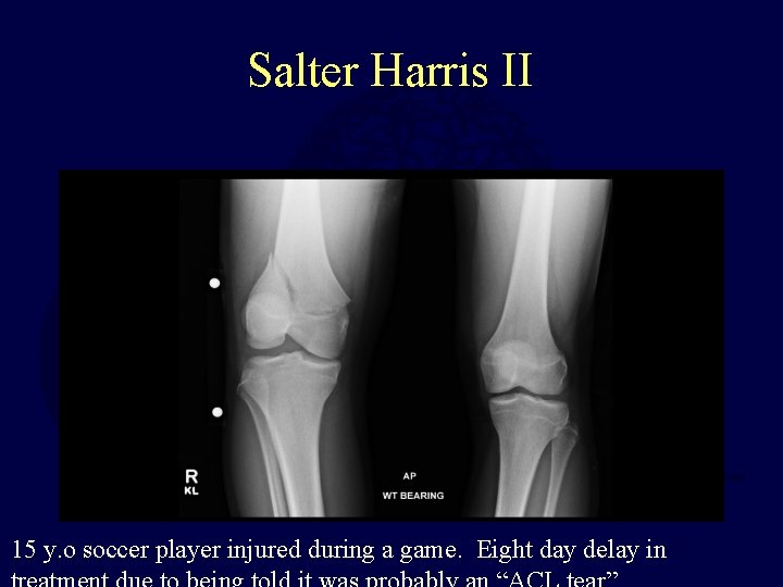 Salter Harris II 15 y. o soccer player injured during a game. Eight day