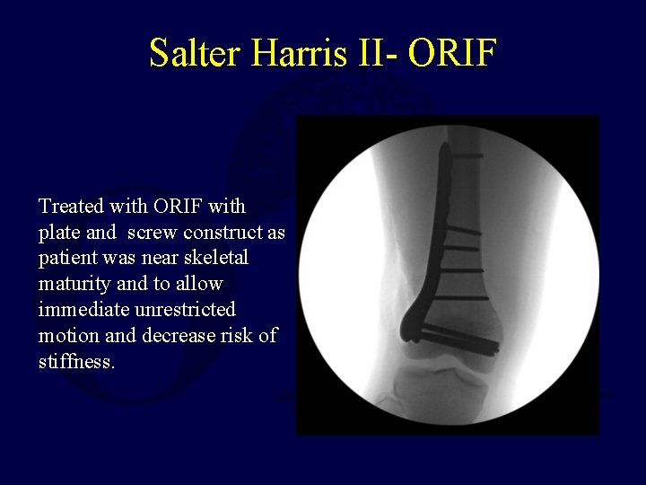 Salter Harris II- ORIF Treated with ORIF with plate and screw construct as patient