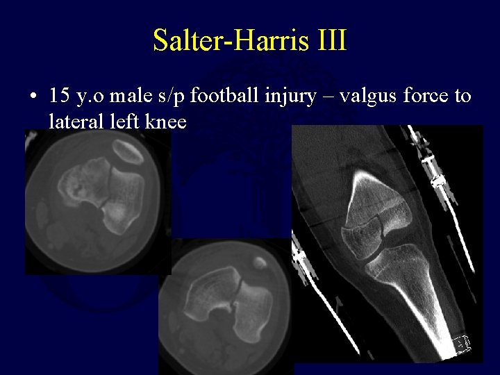 Salter-Harris III • 15 y. o male s/p football injury – valgus force to