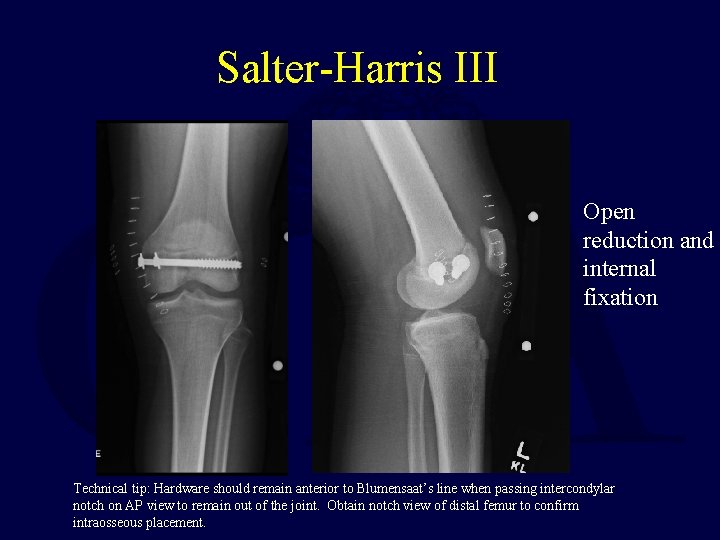 Salter-Harris III Open reduction and internal fixation Technical tip: Hardware should remain anterior to