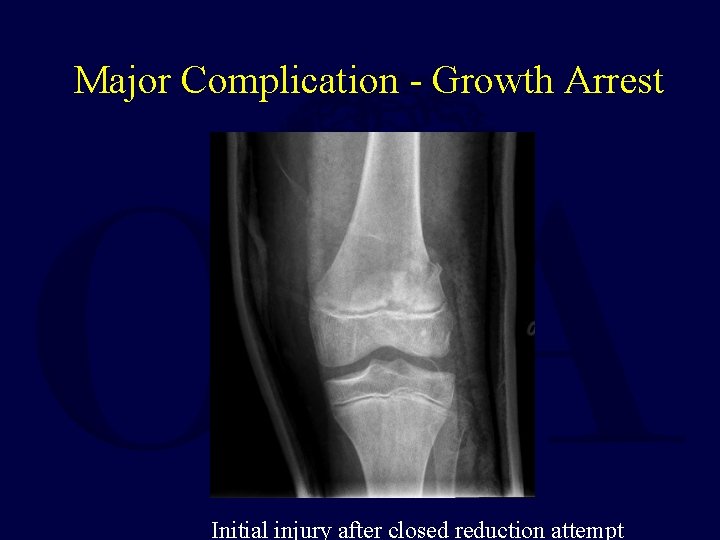 Major Complication - Growth Arrest Initial injury after closed reduction attempt 