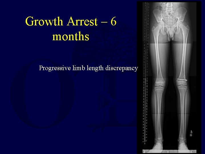 Growth Arrest – 6 months Progressive limb length discrepancy 