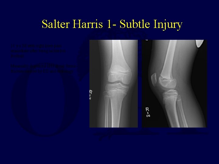 Salter Harris 1 - Subtle Injury 11 y. o M with right knee pain