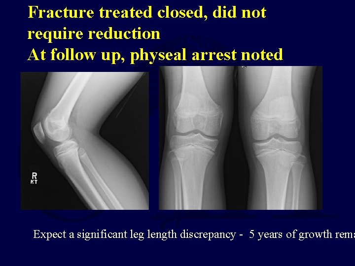 Fracture treated closed, did not require reduction At follow up, physeal arrest noted Expect