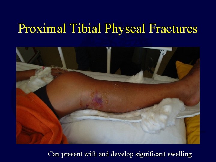 Proximal Tibial Physeal Fractures Can present with and develop significant swelling 