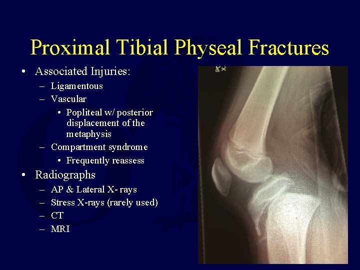 Proximal Tibial Physeal Fractures • Associated Injuries: – Ligamentous – Vascular • Popliteal w/