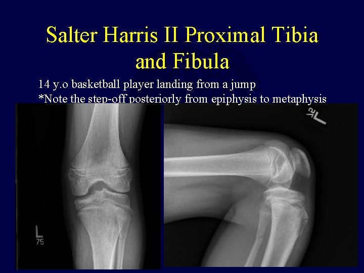 Salter Harris II Proximal Tibia and Fibula 14 y. o basketball player landing from