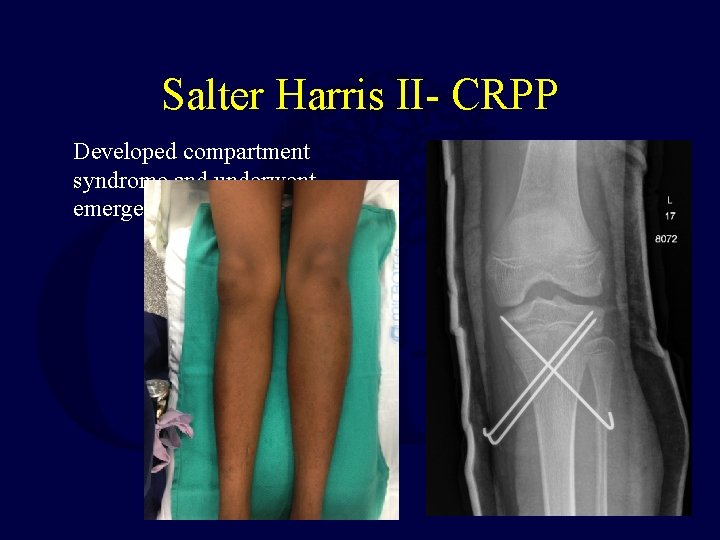 Salter Harris II- CRPP Developed compartment syndrome and underwent emergent fasciotomy and CRPP. 