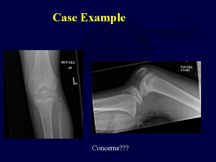 Case Example 10 yo M who was playing football and knee hyperextended when he