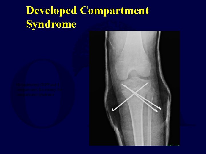 Developed Compartment Syndrome He underwent CRPP and 4 compartment fasciotomy for compartment syndrome 