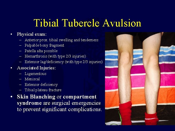 Tibial Tubercle Avulsion • Physical exam: – – – Anterior prox. tibial swelling and