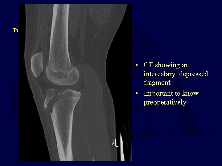 Preop CT • CT showing an intercalary, depressed fragment • Important to know preoperatively