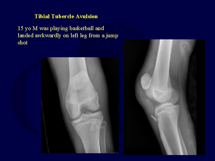 Tibial Tubercle Avulsion 15 yo M was playing basketball and landed awkwardly on left