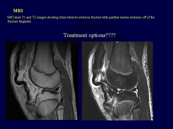 MRI knee T 1 and T 2 images showing tibial tubercle avulsion fracture with