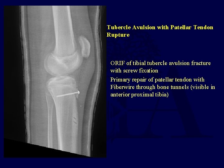 Tubercle Avulsion with Patellar Tendon Rupture ORIF of tibial tubercle avulsion fracture with screw