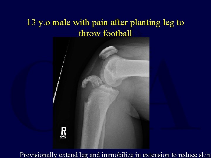 13 y. o male with pain after planting leg to throw football Provisionally extend